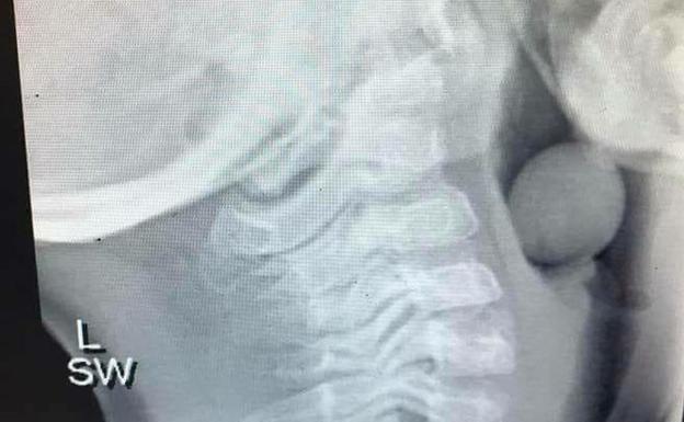 "¡Tenga cuidado!": una madre advierte del peligro de asfixia en los niños